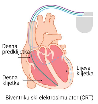 Pacemaker-3-elektrode.jpg.webp