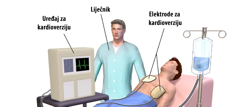 Kardioverzija-HR.jpg.webp